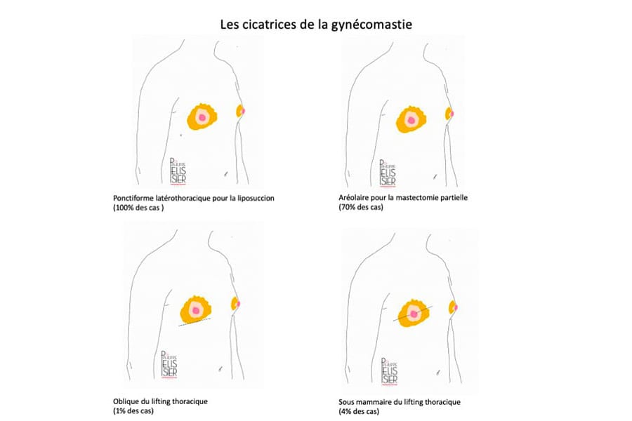 abdominoplastie un an apres chirurgie ventre chirurgie esthetique paris dr philippe pelissier chirurgien plasticien esthetique paris