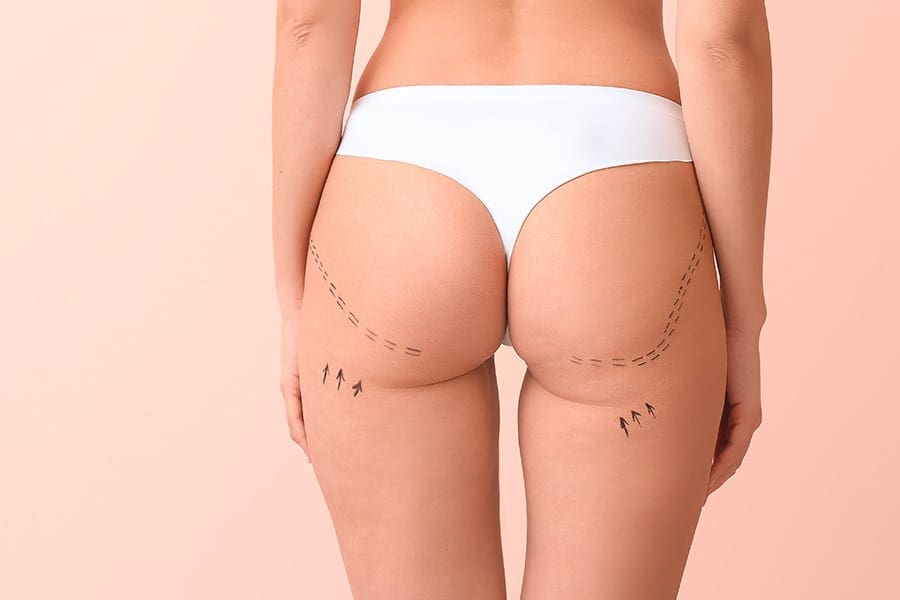 abdominoplastie un an apres chirurgie ventre chirurgie esthetique paris dr philippe pelissier chirurgien plasticien esthetique paris