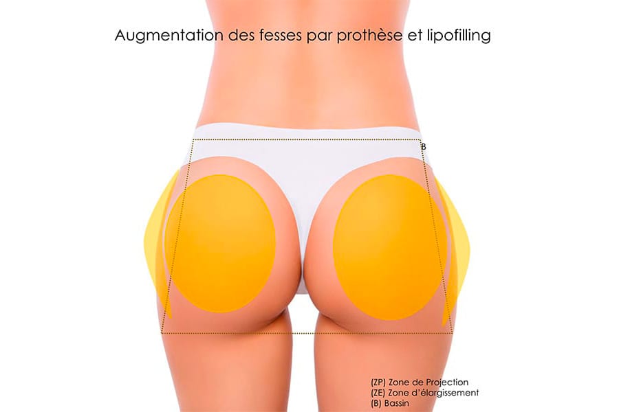 abdominoplastie un an apres chirurgie ventre chirurgie esthetique paris dr philippe pelissier chirurgien plasticien esthetique paris