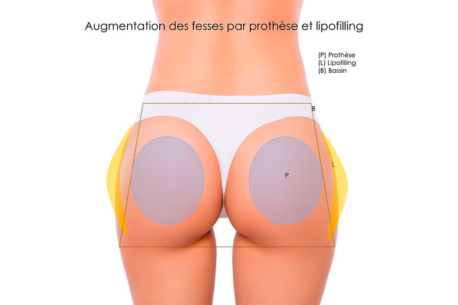 abdominoplastie un an apres chirurgie ventre chirurgie esthetique paris dr philippe pelissier chirurgien plasticien esthetique paris