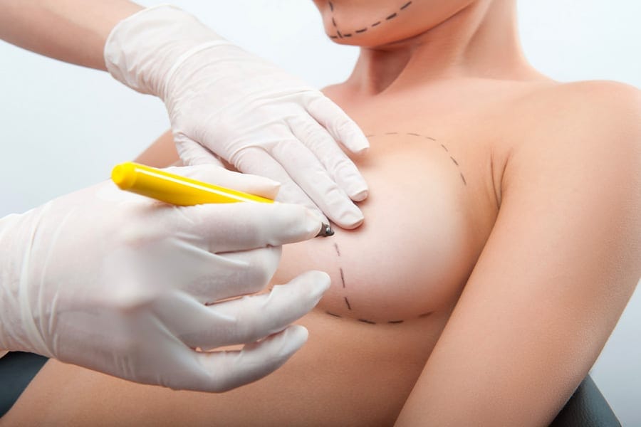 abdominoplastie un an apres chirurgie ventre chirurgie esthetique paris dr philippe pelissier chirurgien plasticien esthetique paris