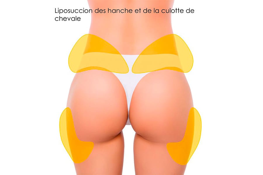 abdominoplastie un an apres chirurgie ventre chirurgie esthetique paris dr philippe pelissier chirurgien plasticien esthetique paris