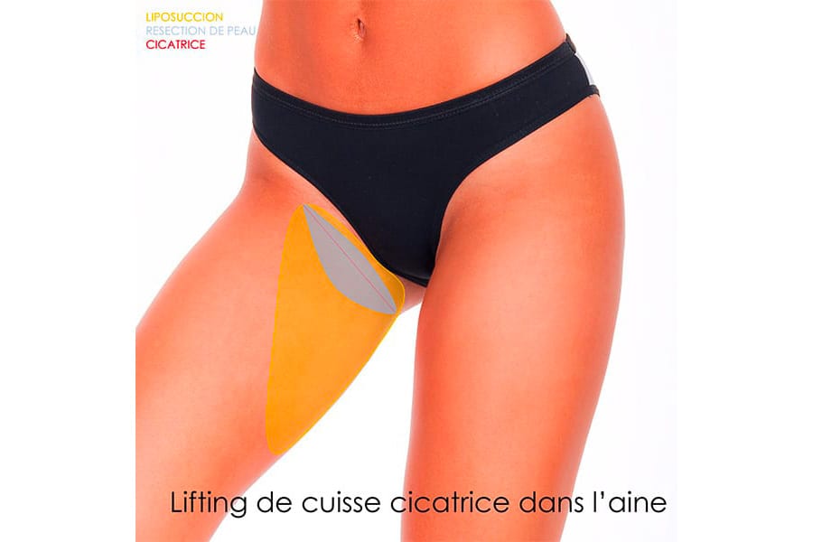abdominoplastie un an apres chirurgie ventre chirurgie esthetique paris dr philippe pelissier chirurgien plasticien esthetique paris