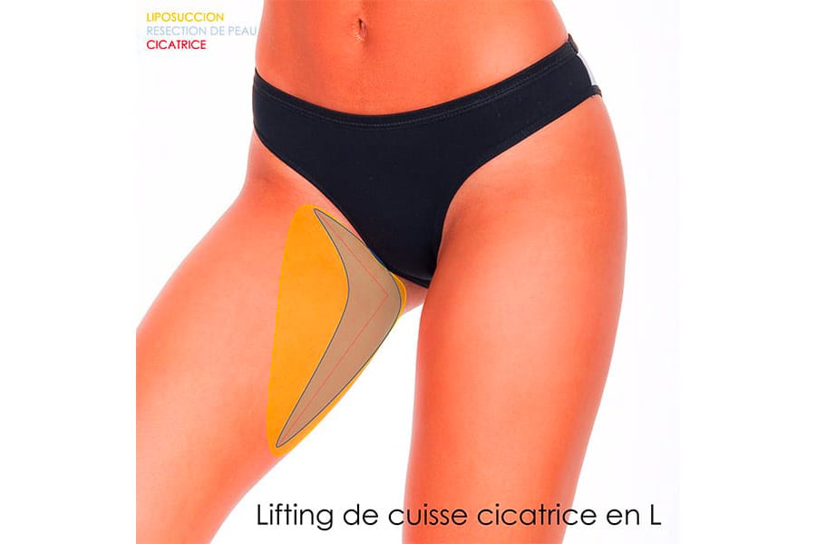 abdominoplastie un an apres chirurgie ventre chirurgie esthetique paris dr philippe pelissier chirurgien plasticien esthetique paris
